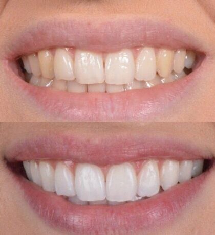 Procedimento de clareamento dental